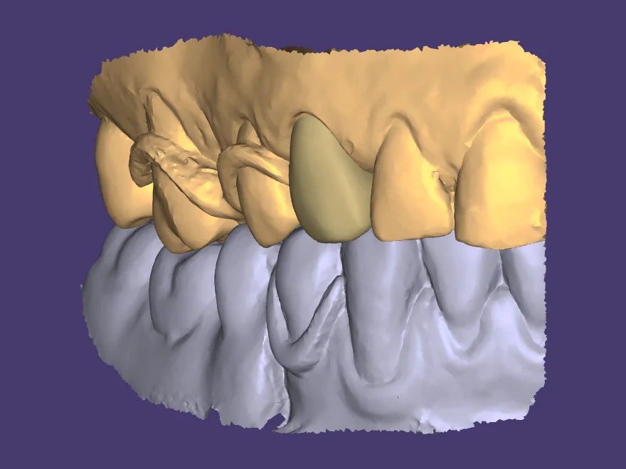 Diseño de una corona sobre el modelo en el visor 3D, con una marca del doctor dibujada encima
